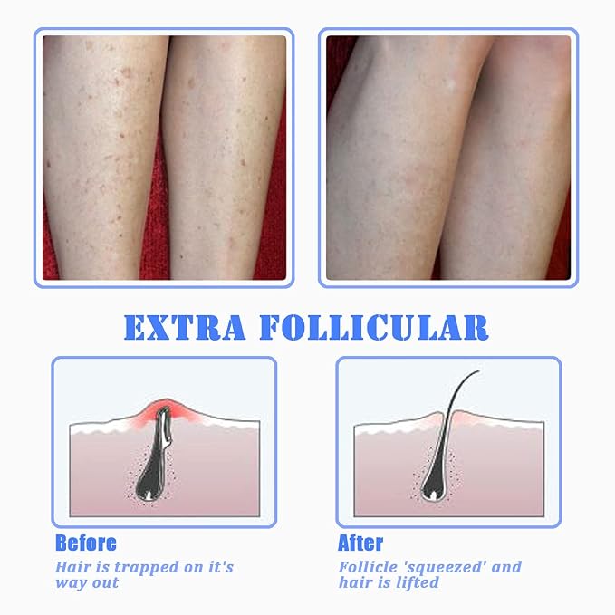 TailaiMei Exfoliating Brush for Ingrown Hair Treatment - To Treat and Prevent Bikini Bumps, Razor Bumps - Silky Smooth Skin Solution for Men and Women(Blue)